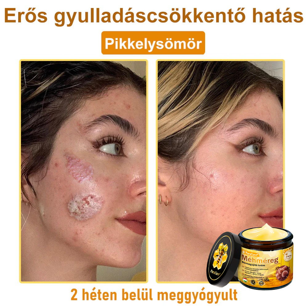 (👨‍⚕‍Bőrgyógyász ajánlása) ✨𝐏𝐮𝐫𝐚𝐂𝐮𝐫𝐞® Méhmérges Bőrmegújító Krém Ráncok,Természetes összetevők, amelyek tartósan eltávolítják a plamokat, szeplőket és napfoltokat, valamint harcolnak a ráncok és megereszkedett bőr ellen — 50 ml👍