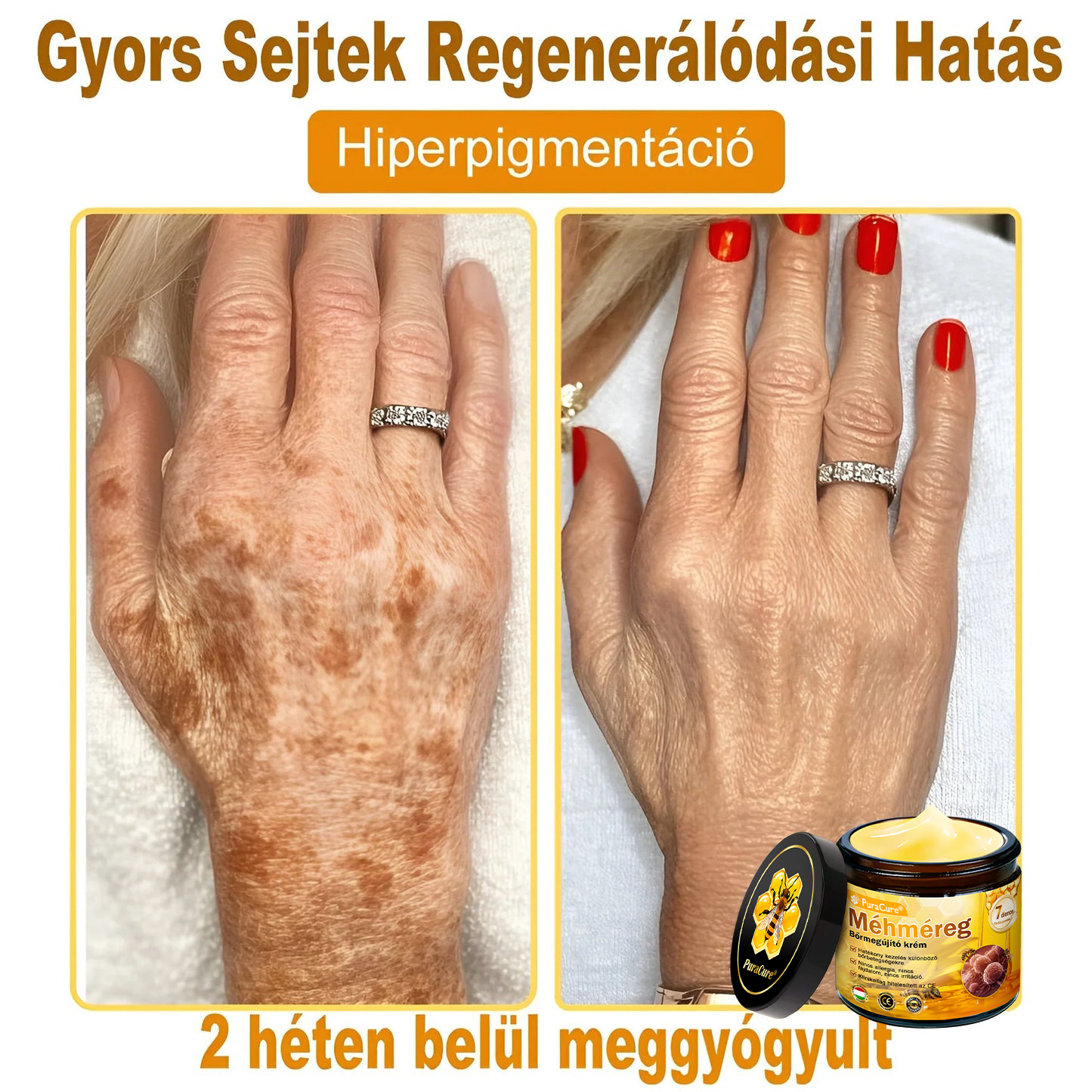 (👨‍⚕‍Bőrgyógyász ajánlása) ✨𝐏𝐮𝐫𝐚𝐂𝐮𝐫𝐞® Méhmérges Bőrmegújító Krém Ráncok,Természetes összetevők, amelyek tartósan eltávolítják a plamokat, szeplőket és napfoltokat, valamint harcolnak a ráncok és megereszkedett bőr ellen — 50 ml👍