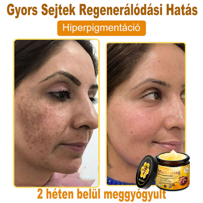 (👨‍⚕‍Bőrgyógyász ajánlása) ✨𝐏𝐮𝐫𝐚𝐂𝐮𝐫𝐞® Méhmérges Bőrmegújító Krém Ráncok,Természetes összetevők, amelyek tartósan eltávolítják a plamokat, szeplőket és napfoltokat, valamint harcolnak a ráncok és megereszkedett bőr ellen — 50 ml👍