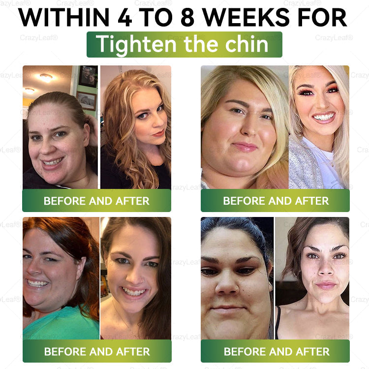 🎁AU Clinically Proven|Official Store | CrazyLeaf® SMGT-GLP-1 Nano Microneedle Patch with Collagen & Matrixyl 3000 丨Targets Obesity, Loose Skin, High Blood Pressure, Diabetes, Fatty Liver, Joint Pain, Brain Fog, Low Energy, Body Aches, and More