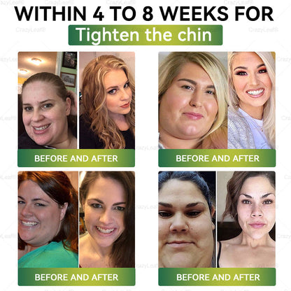 🎁AU Clinically Proven|Official Store | CrazyLeaf® SMGT-GLP-1 Nano Microneedle Patch with Collagen & Matrixyl 3000 丨Targets Obesity, Loose Skin, High Blood Pressure, Diabetes, Fatty Liver, Joint Pain, Brain Fog, Low Energy, Body Aches, and More