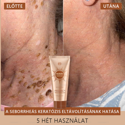 𝐅𝐑𝐈𝐒𝐒𝐀𝐑𝐂™ Fehérítő És Folteltávolító Arcmaszk | Természetes összetevők tartósan eltüntetik a foltokat, szeplőket és napfoltokat