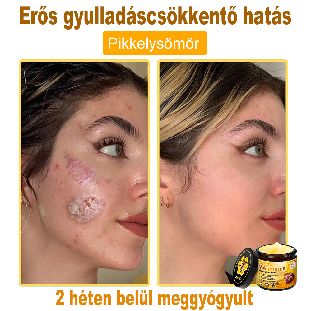 💟Bőrgyógyász ajánlása 🐝 ZödVita® Méhmérges Bőrmegújító Krém Ráncok,Természetes összetevők, amelyek tartósan eltávolítják a plamokat, szeplőket és napfoltokat, valamint harcolnak a ráncok és megereszkedett bőr ellen — 50 ml✨✨✨