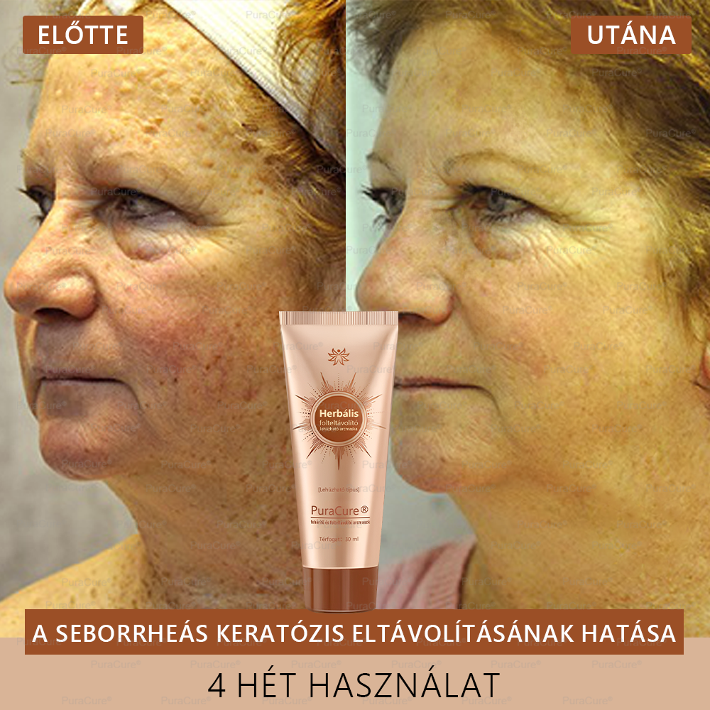 💟𝗣𝘂𝗿𝗮𝗖𝘂𝗿𝗲®Fehérítő És Folteltávolító Arcmaszk | Természetes összetevők tartósan eltüntetik a foltokat, szeplőket és napfoltokat✨