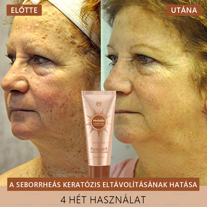 💟𝗣𝘂𝗿𝗮𝗖𝘂𝗿𝗲®Fehérítő És Folteltávolító Arcmaszk | Természetes összetevők tartósan eltüntetik a foltokat, szeplőket és napfoltokat✨