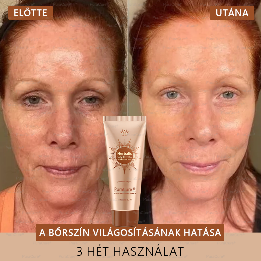 💟𝗣𝘂𝗿𝗮𝗖𝘂𝗿𝗲®Fehérítő És Folteltávolító Arcmaszk | Természetes összetevők tartósan eltüntetik a foltokat, szeplőket és napfoltokat✨