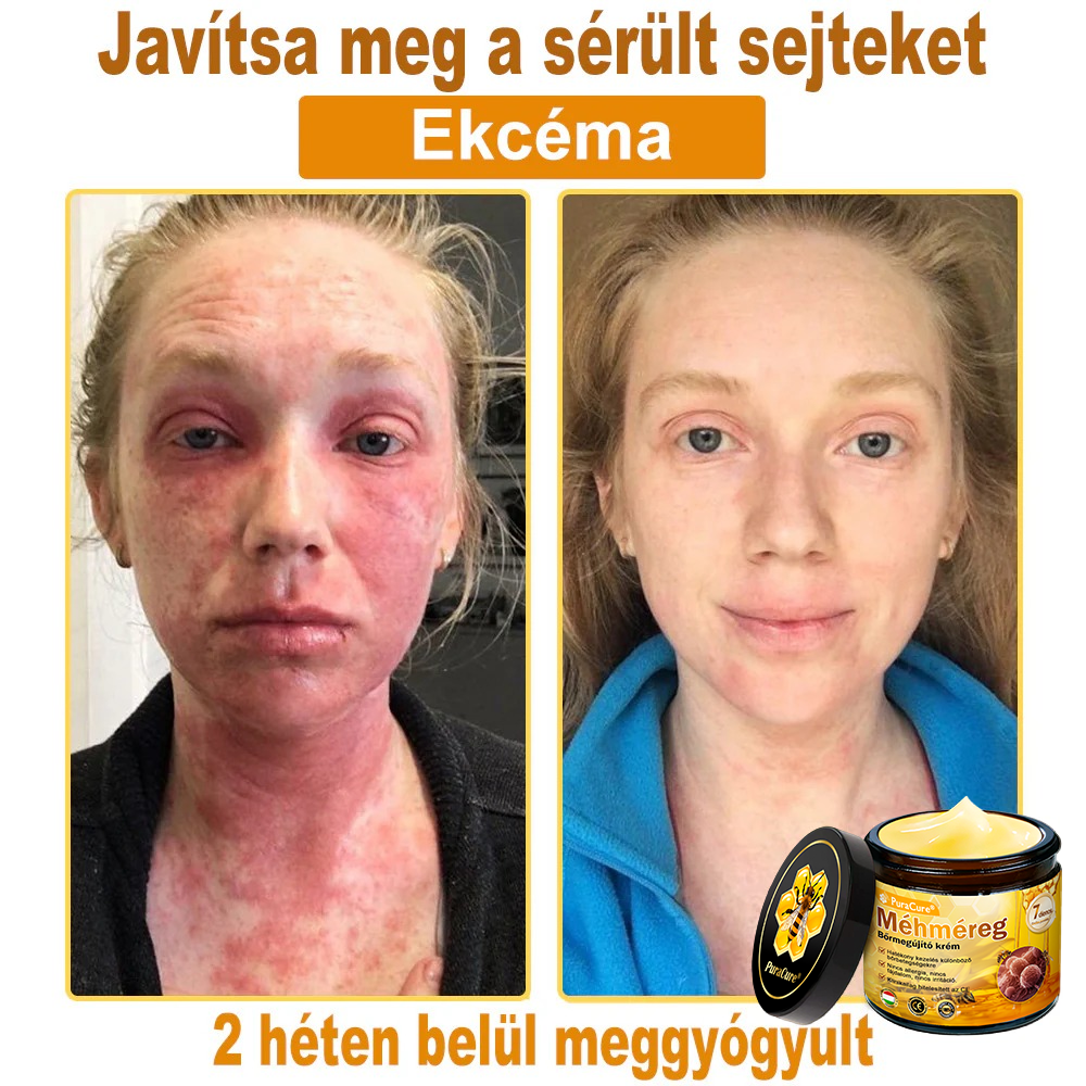 (👨‍⚕‍Bőrgyógyász ajánlása) ✨𝐏𝐮𝐫𝐚𝐂𝐮𝐫𝐞® Méhmérges Bőrmegújító Krém Ráncok,Természetes összetevők, amelyek tartósan eltávolítják a plamokat, szeplőket és napfoltokat, valamint harcolnak a ráncok és megereszkedett bőr ellen — 50 ml👍