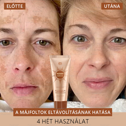 💟𝗣𝘂𝗿𝗮𝗖𝘂𝗿𝗲®Fehérítő És Folteltávolító Arcmaszk | Természetes összetevők tartósan eltüntetik a foltokat, szeplőket és napfoltokat✨