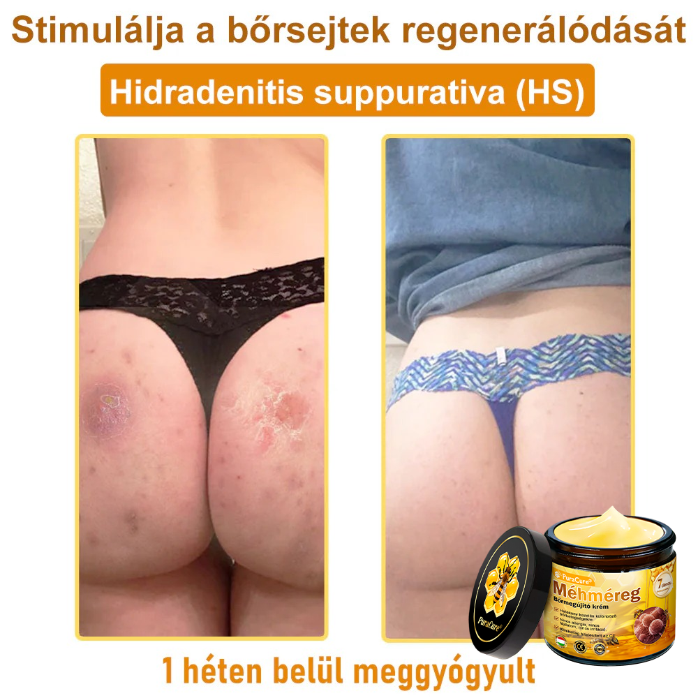 (👨‍⚕‍Bőrgyógyász ajánlása) ✨𝐏𝐮𝐫𝐚𝐂𝐮𝐫𝐞® Méhmérges Bőrmegújító Krém Ráncok,Természetes összetevők, amelyek tartósan eltávolítják a plamokat, szeplőket és napfoltokat, valamint harcolnak a ráncok és megereszkedett bőr ellen — 50 ml👍